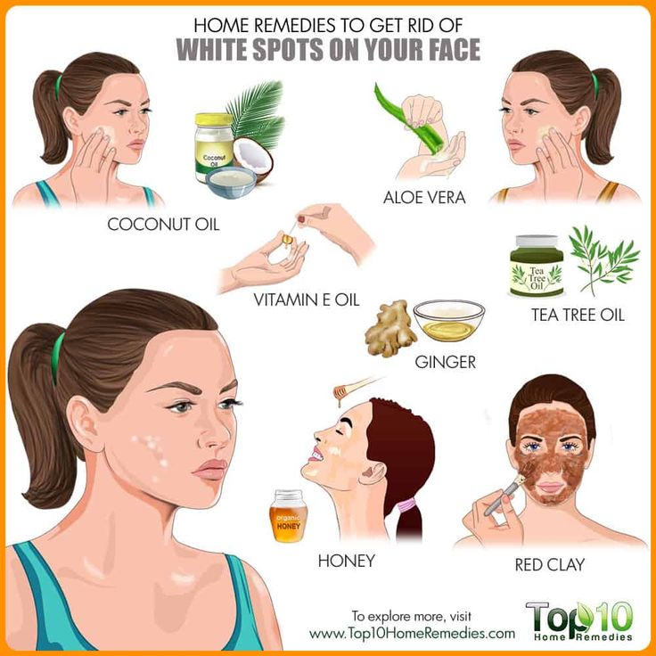 White Spots On Face, White Spots On Skin, White Skin Spots, Spots On Skin, Dark Spots On Skin, Skin Spots, Spots On Face, Flexible Dieting, Face Acne