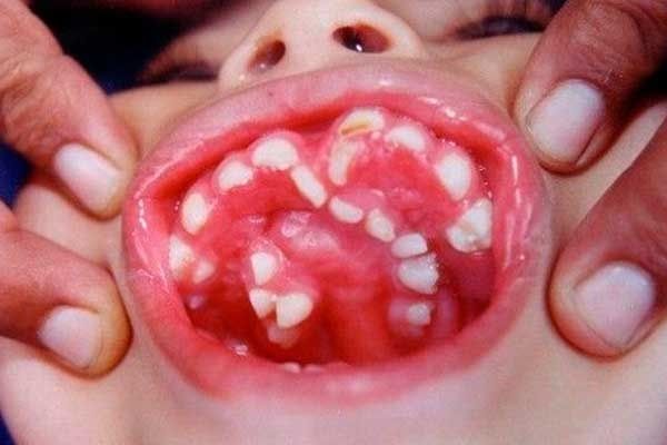 Dentaltown - Hyperdontia is the condition of having supernumerary teeth, or teeth that appear in addition to the regular number of teeth. They can appear in any area of the dental arch and can affect any dental organ. The opposite of this condition is hypodontia, where there is a congenital lack of teeth. This is seen more commonly than hyperdontia. The scientific definition of hyperdontia is "any tooth or odontogenic structure that is formed from tooth germ in excess of usual number for any giv Extra Teeth, Human Oddities, Dental Humor, Unusual Things, Dental Assistant, Dental Hygiene, Weird And Wonderful, Human Body, Medical