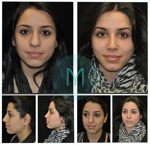 Closed Rhinoplasty, Nose Rhinoplasty, Nose Plastic Surgery, Ethnic Rhinoplasty, Bulbous Nose, Rhinoplasty Nose Jobs, Rhinoplasty Surgery, Pretty Nose, Wide Nose