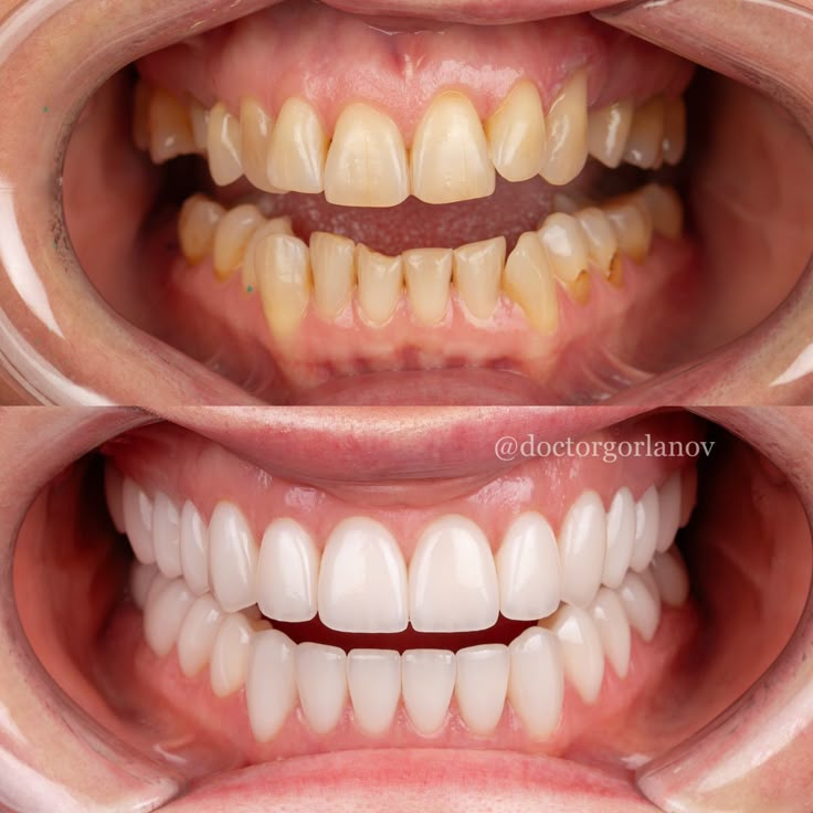 Perfect Teeth Smile, Perfect Smile Teeth, Dental Makeover, Face Plastic Surgery, Loose Teeth, Teeth Aesthetic, Bottom Teeth, Dental Mouthguards, Pretty Teeth