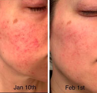 27 Beauty Products That People Who Have Rosacea Swear By Red Bumps On Face, Redness On Face, Rash On Face, Foods For Clear Skin, Skin Bumps, Acne Remedies, Image Skincare, Skin Texture, Anti Aging Skin Care