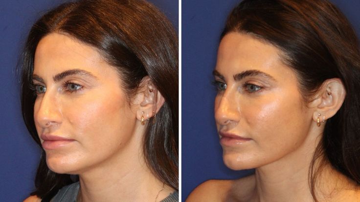 I Tried the “Nefertiti Lift” to Define My Jawline Tech Neck, Botox Cosmetic, Best Primer, Neck Lift, Laser Therapy, Sagging Skin, After Photos, Plastic Surgeon, Tinted Moisturizer