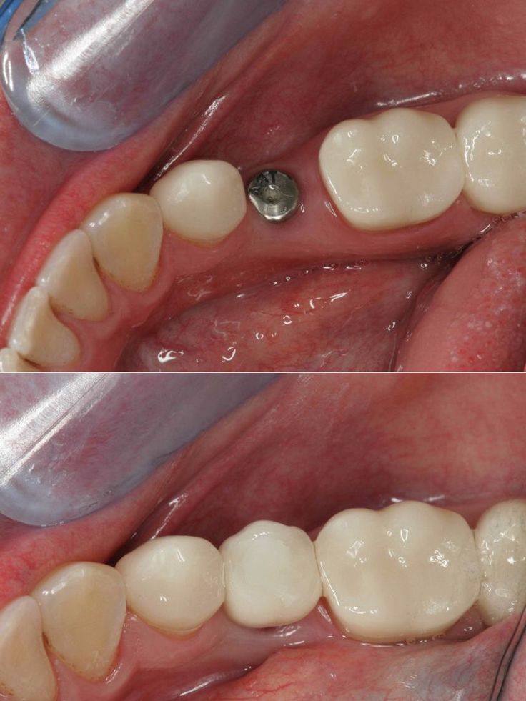 Dental implants are the preferred method of replacing a missing tooth because you can brush and floss around it more easily than a bridge. Dental Bridge Cost, Tooth Extraction Aftercare, Tooth Implant, Tooth Extraction Healing, Affordable Dental Implants, Dental Implant Procedure, Dental Implants Cost, Dental Facts, Whiter Teeth