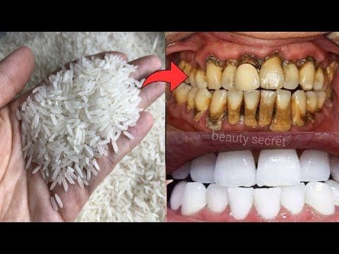 How to whiten your teeth naturally at home in just 1 minute !You will get white teeth like pearls - YouTube Natural Teeth Whitening Diy, Alcohol Free Mouthwash, Tartar Removal, Teeth Whitening Homemade, Get Whiter Teeth, Teeth Whitening Remedies, Teeth Whitening Diy, Beautiful Teeth, Whiten Your Teeth