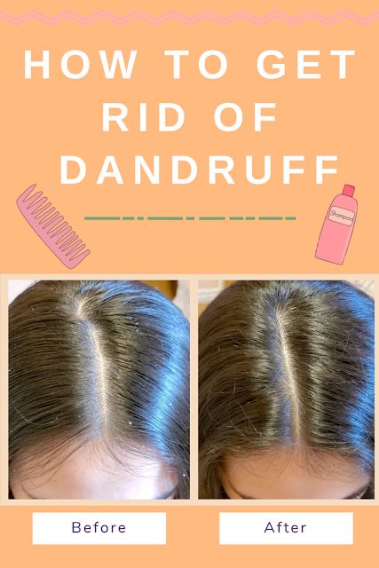 How To Get Rid Off Dandruff, How To Get Rid Of Bad Dandruff, How To Remove Dandruff From Scalp Quick, How To Deal With Dandruff, Ways To Get Rid Of Dandruff, How To Get Dandruff Out Of Hair, How To Fix Dandruff, How To Get Ride Of Dandruff Fast At Home, Best Dandruff Remedy