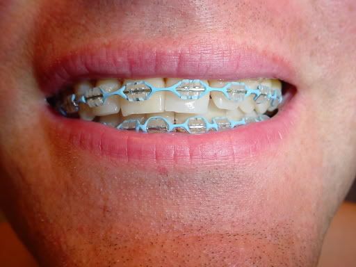 This is a cute color Ceramic Braces Color Bands, Braces Colours, Braces Ideas, Jewelry Teeth, Braces Colors Ideas, Power Chain, Ceramic Braces, Braces Cost, Cute Braces Colors