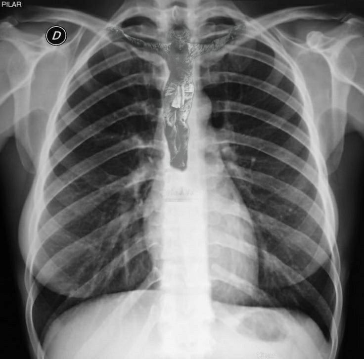 an x - ray shows the chest and ribs