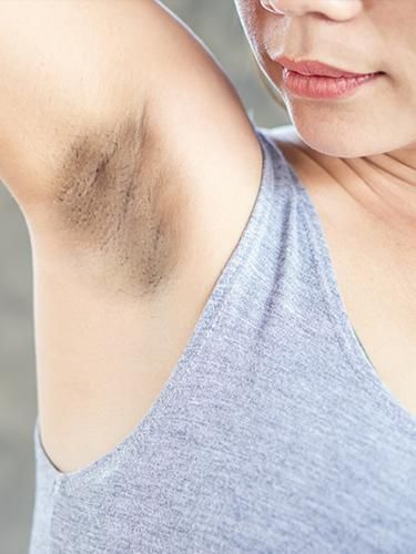 Black Underarms, Black Underarms Remedies, Dark Armpit Remedies, Underarm Darkness, Home Remedy For Dark Underarms, How To Get Rid Of Dark Underarms, Underarm Darkness Remedies, Clean Underarms Dark Armpits, How To Get Rid Of Underarm Darkness