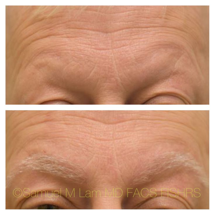 This 59-year-old gentleman who suffered in the past from trichotillomania is shown before and four months after eyebrow hair transplant with a good aesthetic outcome. Eyebrow Hair Transplant, Hair Restoration, Hair Transplant, Gentleman, Eyebrows, Hair Hair, The Past, Hair