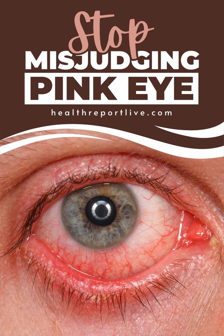 Here is a close up of a persons eye with the words stop missuding pink eye Natural Remedy For Pink Eye, Burning Eyes Relief Remedies, Pink Eye Infection, Viral Pink Eye Remedy, Pink Eye Remedy How To Get Rid Of, How To Get Rid Of Pink Eye Fast, Eye Infection Remedies, Pink Eye Remedies, Pink Eye Remedy