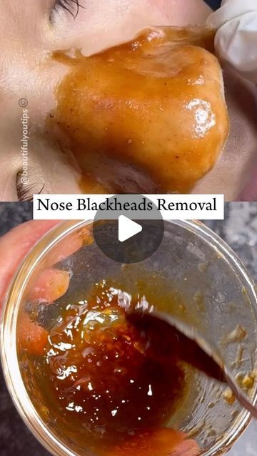 Baking Soda And Apple Cider Vinegar Face Mask, Best Mask For Blackheads, Diy Facemask Skincare Blackheads, Face Mask That Pulls Out Blackheads, How To Make Face Mask For Blackheads, Blackheads Mask Diy, Face Pack For Blackheads, What Helps Get Rid Of Blackheads, How To Make Skin Poreless