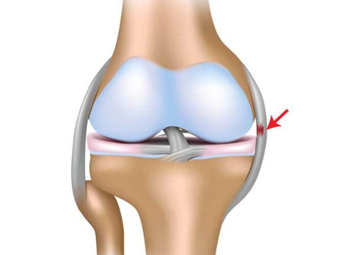 key MCL tear symptoms and learn how to identify and address them effectively. Your guide to understanding MCL tear symptoms for prompt care. - #DescribingMCLtearsymptoms #ExplainMCLtearwarningsignals #HowtorecognizesymptomsofMCLtear? #IndicatorsofMCLrupture #Innerkneeligamenttearsigns #Kneejointtearmanifestations #Kneeligamenttearsymptoms #MCLdamagesymptoms #MCLruptureindicators... Knee Ligaments, Ligament Tear, Warm Up Routine, Medical Examination, Body Ache, Knee Injury, Medical History, Wellness Tips, Healthcare Professionals