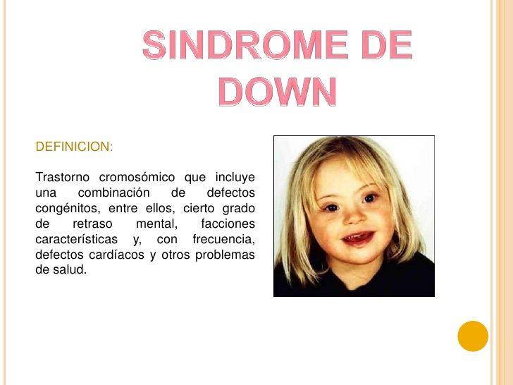 caracteristicas del sindrome de down