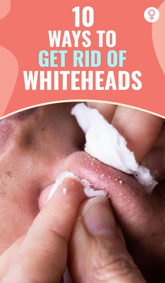 White Heads On Nose, Nails Remedies, Natural Hair Removal Remedies, Diy Nail Care, Different Types Of Acne, Prevent Pimples, Blackheads On Nose, Clean Blackheads, Get Rid Of Pimples