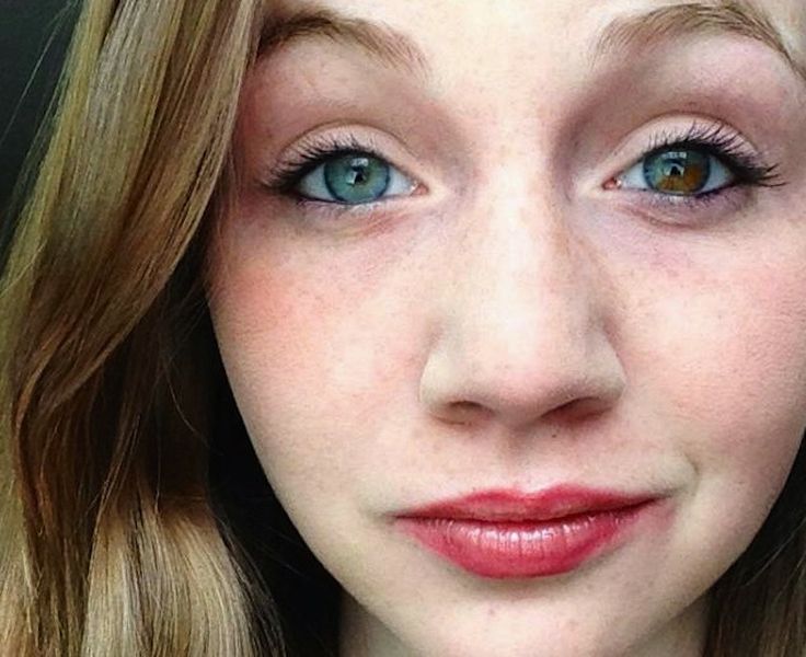 Sectoral Heterochromia #sectoral #heterochromia #eyes #people #beautiful #girl Girls With Heterochromia, Two Different Eye Colors, Two Colored Eyes, Sectoral Heterochromia, Multicolored Eyes, Character Eyes, Heterochromia Eyes, Two Different Colored Eyes, Blonde Green Eyes