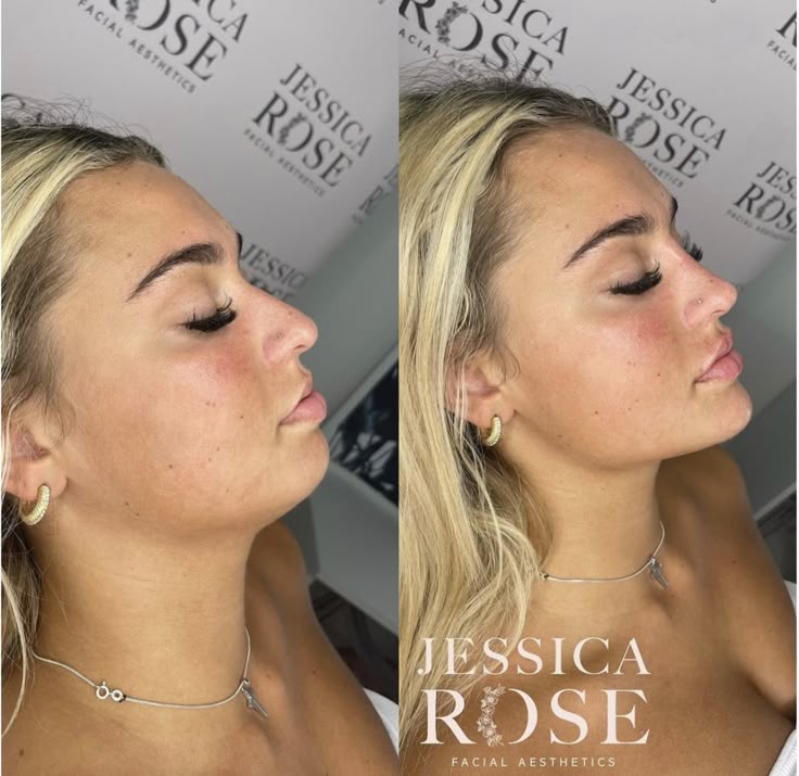 Jaw And Cheek Filler, Plastic Surgery Jawline, Chin Plastic Surgery Before After, Filler Face Contouring, Chin And Cheek Fillers, Cheek And Jaw Fillers, Chin Jaw Filler, Cheek And Chin Filler, Nose Job Filler