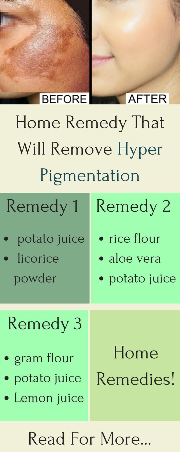 Pigmentation Remedy, Black Spots On Face, Sunspots On Face, Spots On Forehead, Brown Spots On Hands, Brown Age Spots, Aloe Vera Powder, Brown Spots On Skin, Hyper Pigmentation