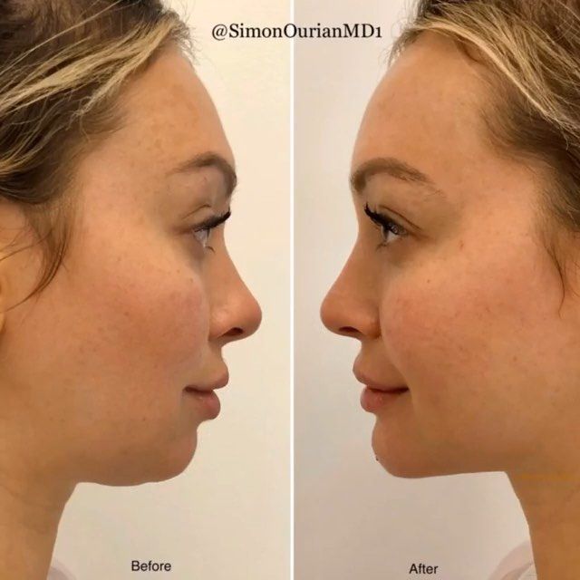 📐When an angel gets angles! . @simonourianmd1 showcases his talents at reshaping faces using injectable fillers. This patient's weak chin… Chin Contouring, Weak Chin, Beauty Procedures, Beauty Makeover, Injectables Fillers, Cosmetic Procedures, An Angel, Beauty Care, Beverly Hills