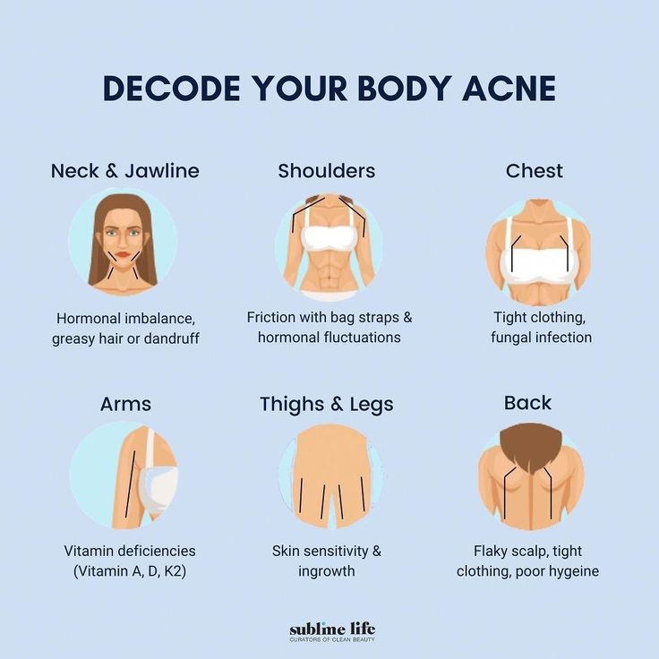 Arm Acne, Shoulder Acne, Back Acne Remedies, Chest Acne, Forehead Acne, Skin Facts, Natural Acne Remedies, Body Acne, Skin Condition