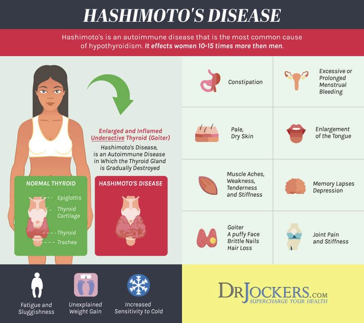 Hashimoto's Thyroiditis: Causes, Symptoms and Solutions Thyroid Healing Diet, Study Binder, Dr Jockers, Thyroid Healing, Thyroid Test, Healing Diet, Autoimmune Diet, Hashimotos Disease, Thyroid Issues