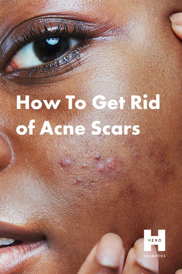 How To Get Rid Of A Pimple Scar, Pimple Scars Removal, How To Remove Acne Marks At Home, How To Clear Acne Scarring, How To Get Rid Of Pimple Scars, How To Get Rid Of Hyperpigmentation, Hyperpigmentation How To Get Rid Of, Best Acne Scar Removal, Getting Rid Of Scars