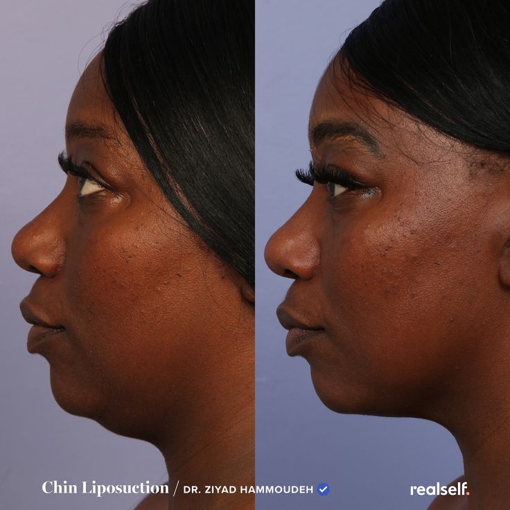 Chin lipo costs $3,000 on average, according to RealSelf members, but your price could range from under $1,000 to nearly $5,000, depending on the specifics of your surgery. Double Chin Surgery, Vaser Lipo, Lipo Before And After, Skin Tightening Procedures, Chin Implant, Skin Tightening Treatments, Beauty Procedures, Facial Plastic, Is It Worth It