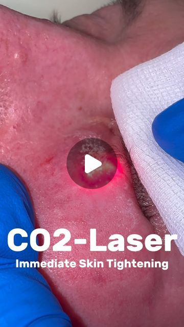 Raphael Weiland on Instagram: "Immediate skin tightening with our CO2-Laser 🤩 #sthetic #co2laser #hautstraffung #skintightening" Skin Tightening, Skin, On Instagram, Instagram