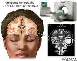 Migraine Information | Mount Sinai - New York Mental Disabilities, Cat Scan, Migraine Prevention, Brain Tissue, Brain Surgery, Chronic Migraines, Migraine Headaches, Dream Catchers, Les Paul