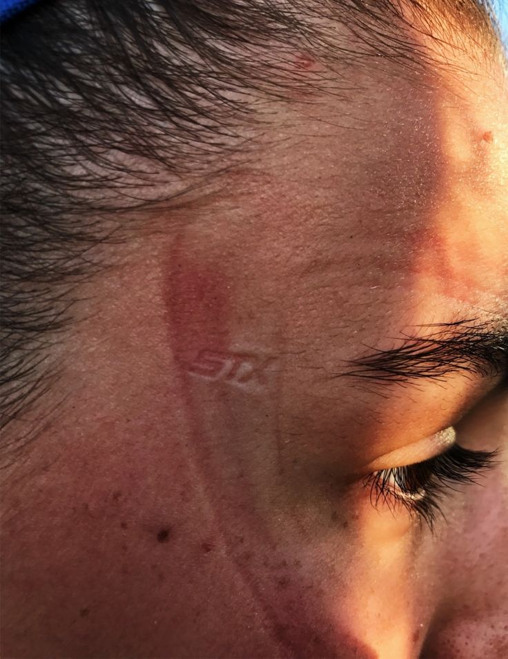 a close up of a person's face with sunburns on his forehead