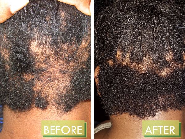 Don't give up on growing your own great hair. Now with our RENEWAL+ Growth Complex. Our unique blend of herbal plant ingredients promote healthier, thicker, and more lush hair after only 30 days of use. Just look at our many before and after pictures. Field trials have shown great results on those who advised that they suffer from long term post partum alopecia, alopecia areata, and early female pattern baldness. Use along with our Heal & Grow Botanical Oil for great results. Results may var Alopecia Hair Growth, Lush Hair, Before And After Hair, Alopecia Hairstyles, Ayurvedic Hair Care, Natural Hair Regrowth, Baked Penne, Female Pattern Baldness, Hair Growth Cycle