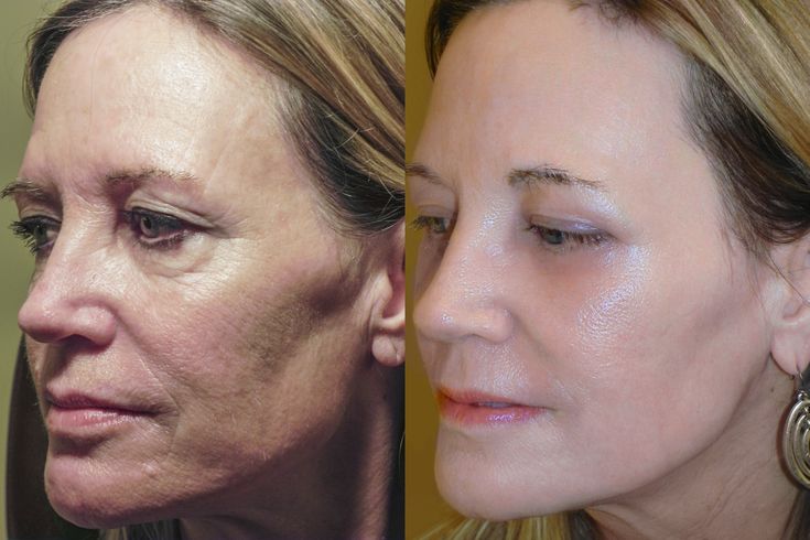 touched. Laser Skin Resurfacing, Make Up Inspiration, Sun Damaged Skin, Facial Rejuvenation, Skin Resurfacing, Lighter Skin, Laser Skin, Anti Aging Tips, Dry Skin Care