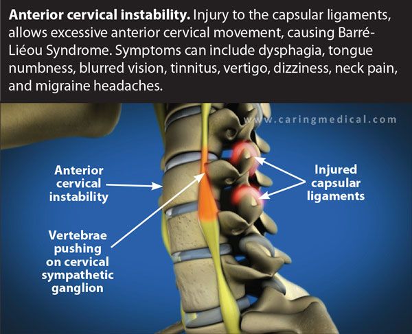 Can A Back Injury Cause Dizziness - mapasgmaes