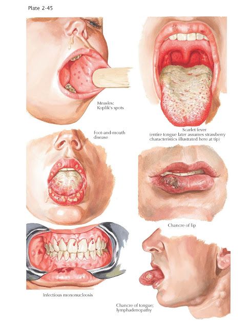 Oral Manifestations in Systemic Infections   Oral manifestations can be observed in almost every generalized systemic infectious disease.... Soft Palate, Dental Health Care, Dental Hygiene School, Basic Anatomy And Physiology, Nursing School Survival, Nursing School Studying, How To Prevent Cavities, Medical Anatomy, Anatomy And Physiology