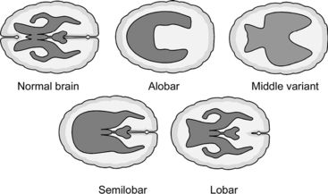 Types of Holoprosencephaly | Diagnostic medical sonography, Medical ...