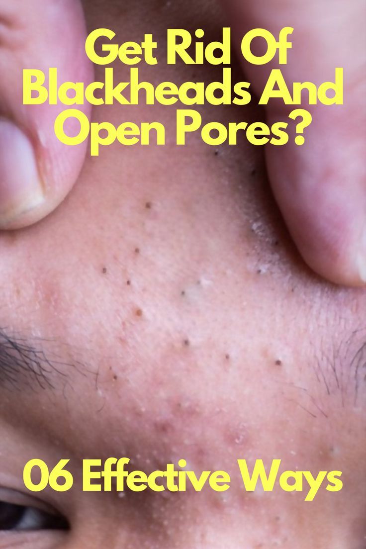 Get Rid Of Blackheads And Open Pores? 06 Effective Ways Solution For Blackheads, Clearing Blackheads, How To Clear Pores On Face, Skin Pores Remedies, How To Remove Black Heads From Face, How To Remove Blackheads At Home, Removing Blackheads, Home Remedies For Blackheads, Remove Blackheads