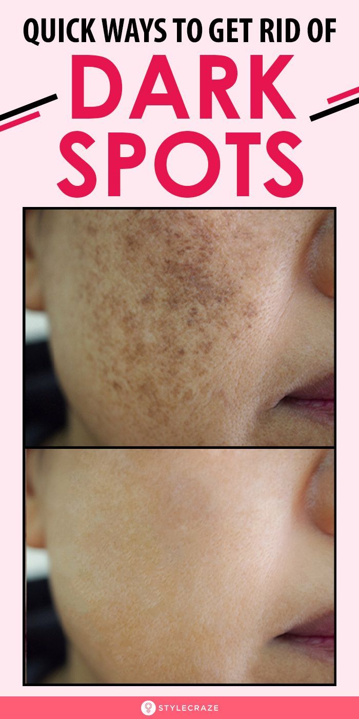 Age Spots On Face, Brown Spots On Skin, Dark Spots On Face, Brown Spots Removal, Brown Spots On Face, Dark Spots On Skin, Skin Spots, Spots On Face, Lighten Dark Spots