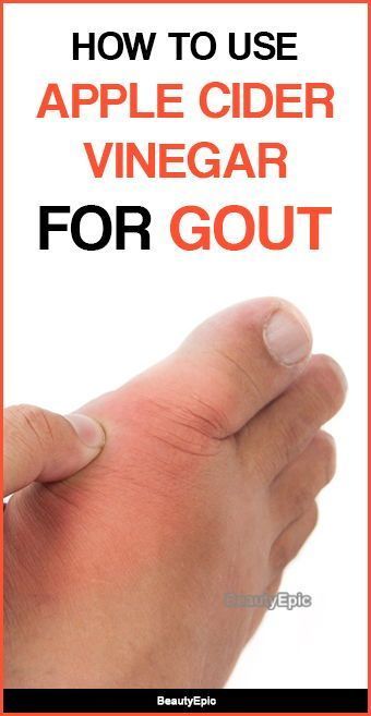 How to use Apple Cider Vinegar for Gout Cold Sores Remedies, Natural Sleep Remedies, Natural Cold Remedies, Uric Acid, Cold Home Remedies, Natural Cough Remedies, Natural Home Remedies, Cider Vinegar, Apple Cider Vinegar