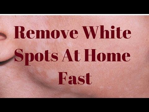 White Spots On Face, White Spots On Skin, White Skin Patches, White Skin Spots, Spots On Skin, Remove Skin Tags Naturally, Blind Pimple, Pimples Under The Skin, Spots On Legs