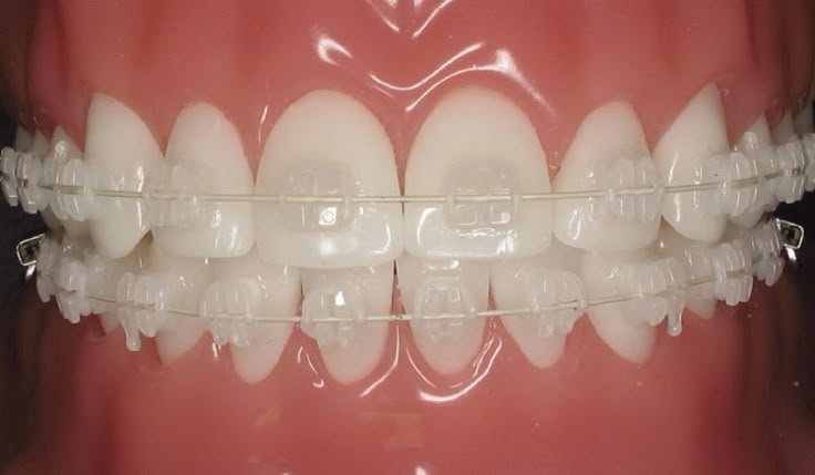 Braces Types, Different Types Of Braces, Silver Braces, Braces Ideas, Ceramic Braces, Braces Cost, Types Of Braces, Adult Braces, Kima Sofia