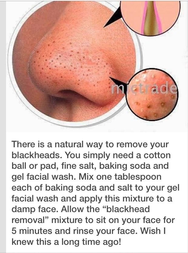 Black Heads, Remove Blackheads, Clear Skin Tips, Skin Care Solutions, Body Skin Care Routine, Diy Skin Care, Diy Skin, Healthy Skin Care, Beauty Skin Care Routine