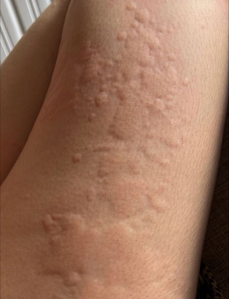 the back of a woman's legs with lots of brown spots on her skin