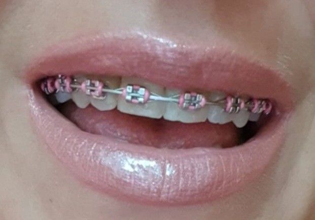 Baby Pink Braces, Light Pink Braces, 13 Going On 30 Jenna, Vienna Video, Braces Pink, Perfect Teeth Braces, New York 2000s, Best Braces Colors, Brace Colors