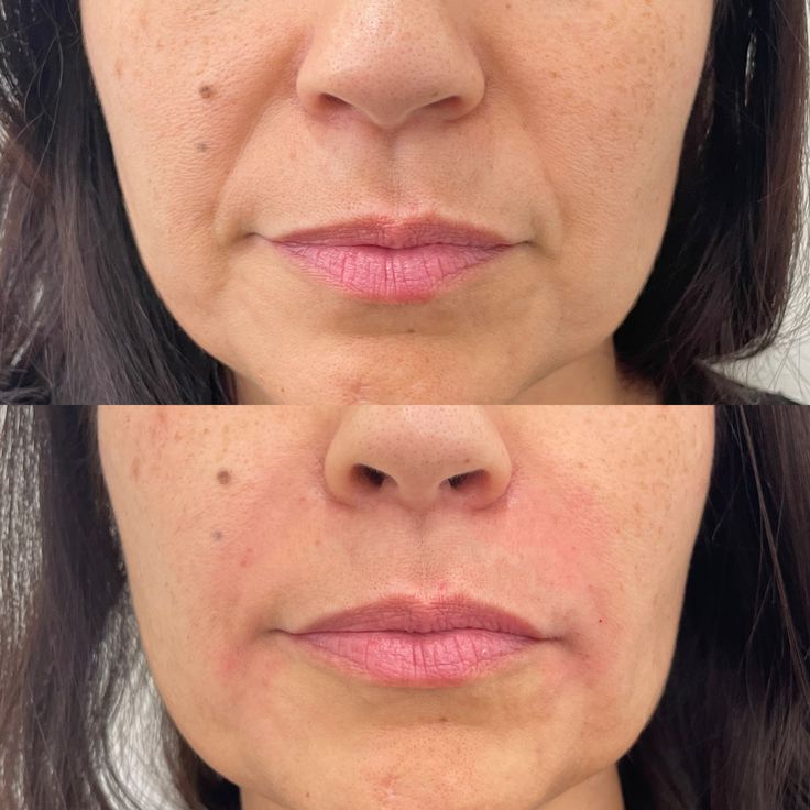 Filler Boosts 29 Facial Harmonization Before And After, Fillers Before And After, Cheek Fillers Before And After Face, Vogue Pictures, Pdo Thread Lift, Botox Results, Shea Butter Benefits, Prp Hair, Skin Booster