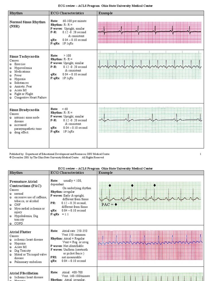 Abnormal Ecg Examples