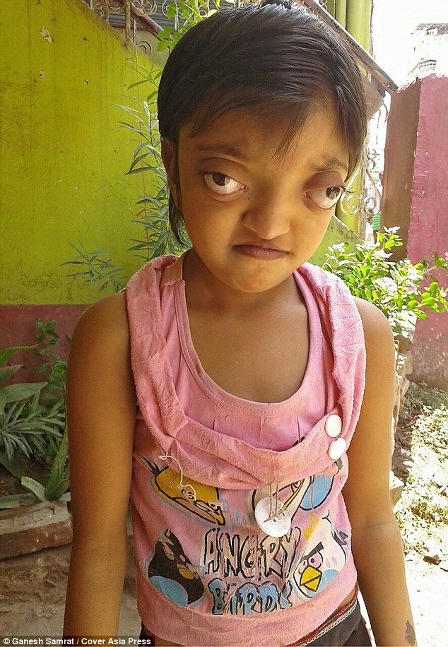 Shaili Kumari suffers from a genetic disorder called Crouzon syndrome - causing her head to be misshapen and giving her the appearance of bulging eyes Cat Eye Syndrome, Eyes Looking Down, Indian Eyes, Human Oddities, Bulging Eyes, Different Colored Eyes, Social Media Impact, Post Human, Genetic Disorders