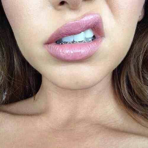 a close up shot of a woman's lips with braces