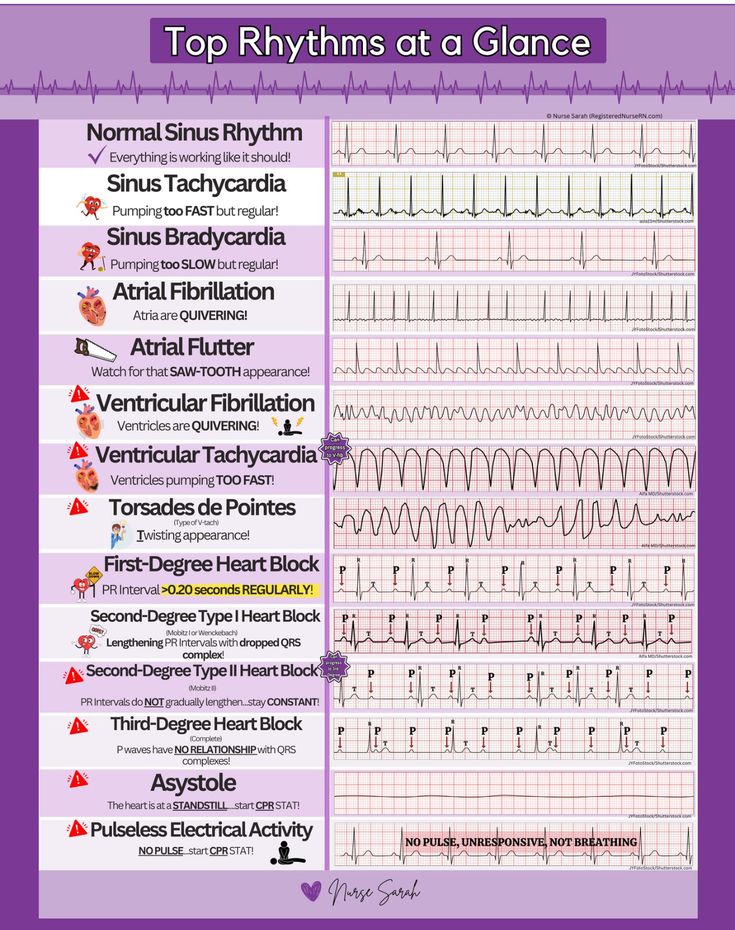 Cardiac Rhythms Ekg Interpretation, Ekg Arrythmias, Cardiac Dysrhythmias Nursing, Junctional Rhythm Ekg, Ekg For Dummies, Cardiac Monitor Tech, Cardiac Arrhythmias Nursing, Cardiac Diseases Nursing, Cardiac Meds Nursing