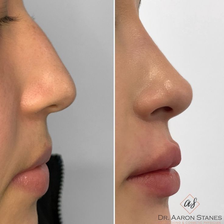 Nose Job Inspiration Straight, Nose Job Side Profile, Best Noses, Cute Nose Front View, Side Nose Profile, Front Nose Profile, Nose Job Natural, Turkish Rhinoplasty, Button Nose Job