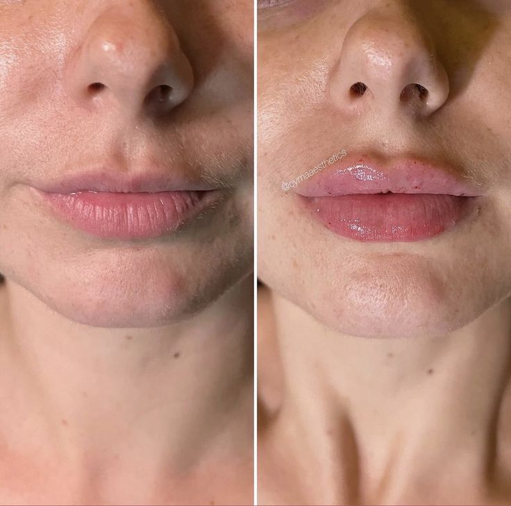 Filler Transformation, 1ml Lip Filler, Cosmetic Injector, Face Plastic Surgery, Smooth Skin Body, Juvederm Lips, Derma Fillers, Lips Inspiration, Natural Pretty