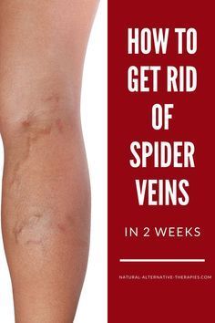 How to quickly and naturally get rid of spider veins (not varicose veins!) - with the best topical home remedies and lifestyle changes that anyone can make. Home Remedies For Spiders, Varicose Vein Removal, Get Rid Of Spiders, Varicose Vein Remedy, Vein Removal, Creme Anti Age, Natural Home Remedies, Natural Treatments, My Health